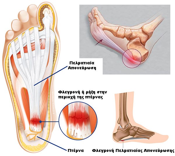 plantar fasciiti
